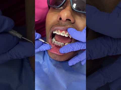 ¿Por qué me sangra la encía si yo me lavo los dientes todos los días?