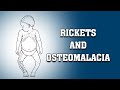 RICKETS AND OSTEOMALACIA