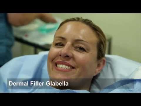 Dermal Filler Glabella