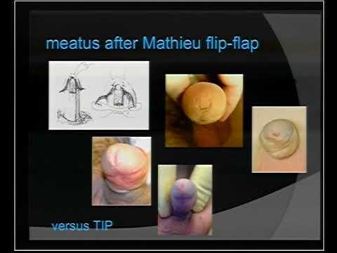 PedUroCon Evidence based pediatric Urology Dr.  Warren Snodgrass