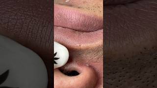 Lip acne #shortvideo #acne #blackheads