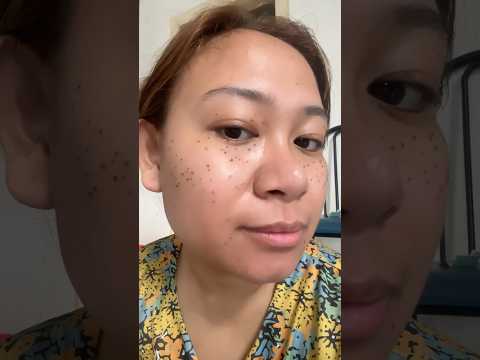 My face after 2 days of having my Face Warts Removal! 😌 #wartsremoval #facewartsremoval #shorts