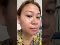 My Face After 2 Days Of Having My Face Warts Removal Wartsremoval Facewartsremoval Shorts