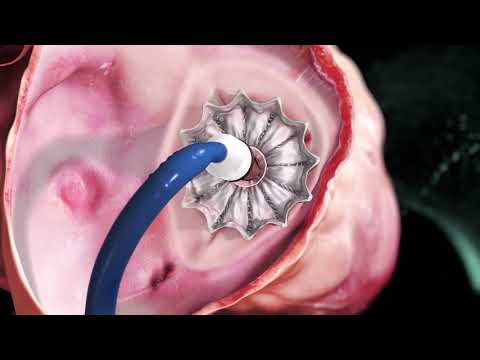 CARDIOVALVE Tricuspid Animation