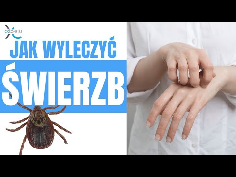 Jak wyleczyć świerzb? www.sklep.cxscabies.pl