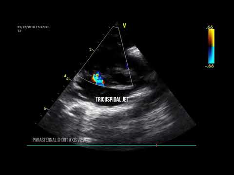 PERSISTENT PULMONARY HYPERTENSION IN THE NEONATE.