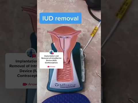 Intra Uterine Device (IUD) Implantation and Removal