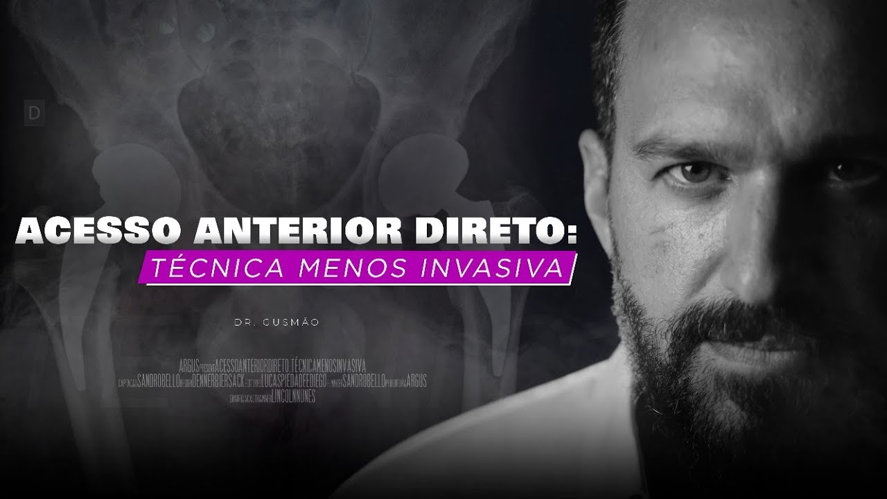 Acesso Anterior Direto na Prótese de Quadril, técnica menos invasiva - Dr. David Gusmão e MeuQuadril