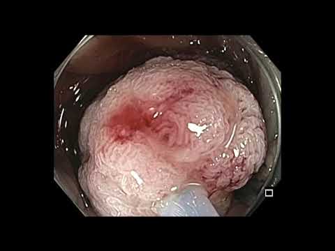 Colonoscopy: Giant Rectal Polyp Resection Avoids Surgery