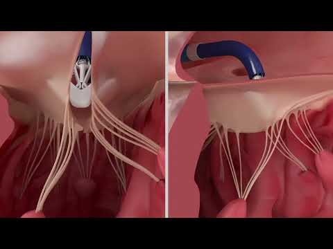 PASCAL Precision System – Implantation of the device in the tricuspid valve