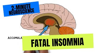 2-Minute Neuroscience: Fatal Insomnia