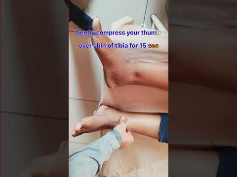 how to check for pedal odema/edema | Leg swelling | #shorts #edema #swelling