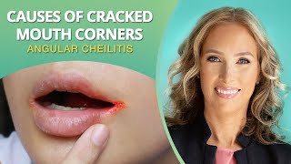 What Causes Mouth Corner Cracks | Angular Cheilitis | Dr. J9 Live