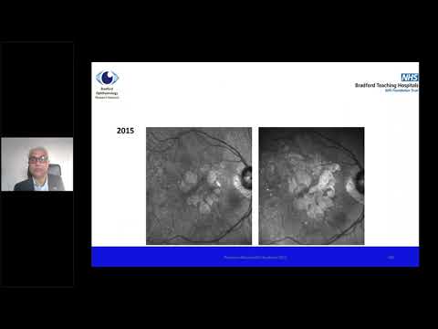 Recorded Webinar: Identifying MNV with OCTA Imaging