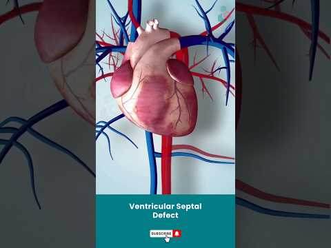 Ventricular Septal Defect Surgery ↪ 3D Medical Animation #Shorts #VSD #VentricularSeptalDefect