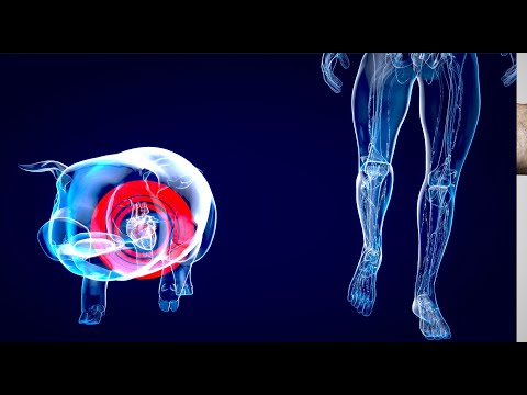 Pigs save lives – Xenotransplantation as the future of transplant medicine