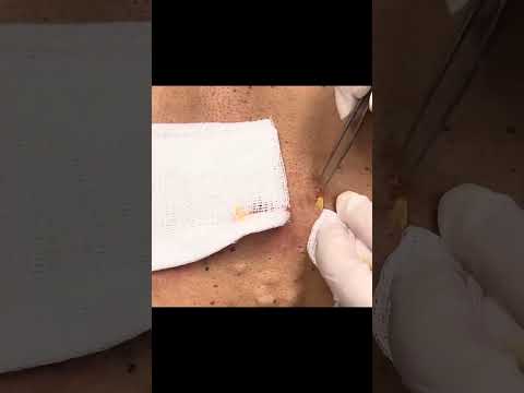 Deep extraction of a solid growth #dermatology #skincare