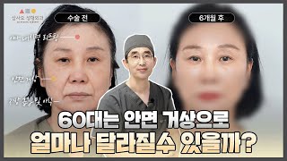 60대도 40대로 만든다...? 한규남 원장님의 안면 거상 리프팅!_[삼사오 성형외과]