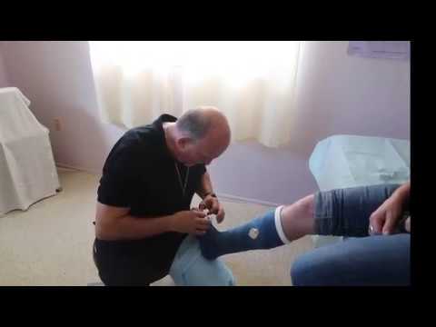 Short Leg with Exogen Bone Stim port