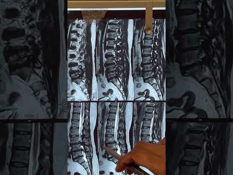 How does MRI / X-ray look in Lumbar canal stenosis : Listhesis