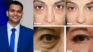 Under Eye Home Remedy | Remove Under Eye Bags Completely | Remove Dark Circle, Wrinkles, Puffy Eyes