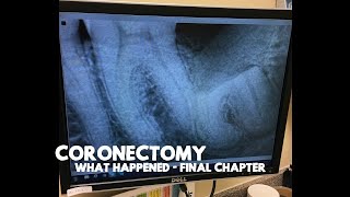 Coronectomy Risks - Follow Up: What Happened