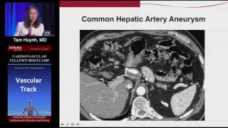 Download Lagu Management of Visceral Artery Aneurysms (Tam Huynh, MD) Sunday, August 21, 2016 Thumbnail