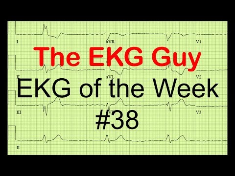 EKG/ECG of the Week #38 | The EKG Guy - www.ekg.md