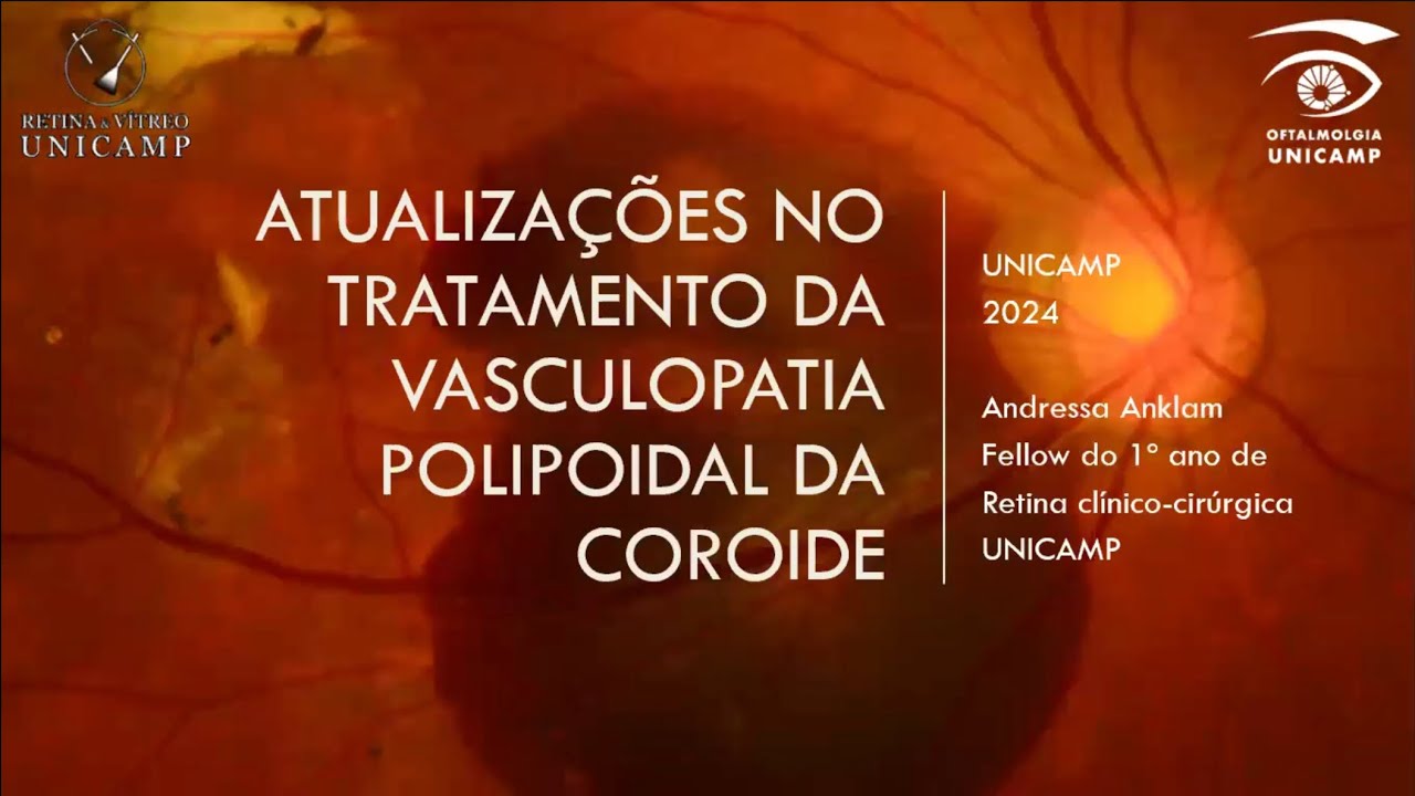 Retina e Vítreo (13/06/2024) - Atualizações no Tratamento da Vasculopatia Polipoidal da Coroide
