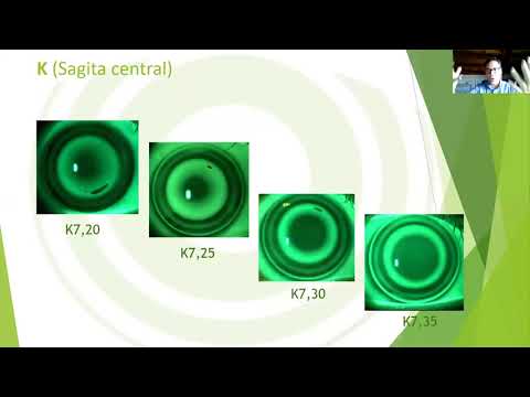 DRL. La ortoqueratología que quieres