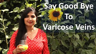 Best Natural Home Remedy To Cure Varicose Veins /  Get Relief from Varicose Vein Pain