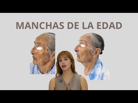 MANCHAS DE LA EDAD ( LENTIGOS SOLARES )