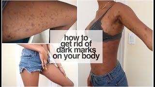 HOW TO GET RID  OF DARK MARKS ON YOUR BODY | Bells and Zibs