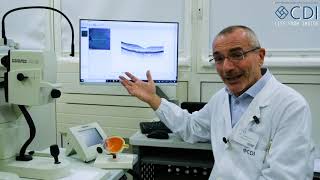 Degenerazione maculare senile: una nuova terapia