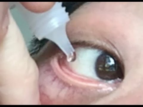 How to use eye drops properly. How to put eyedrops in your own eyes.