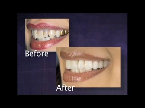 (Vietnamita) Coroas e pontes Prismatik Clinical Zirconia™