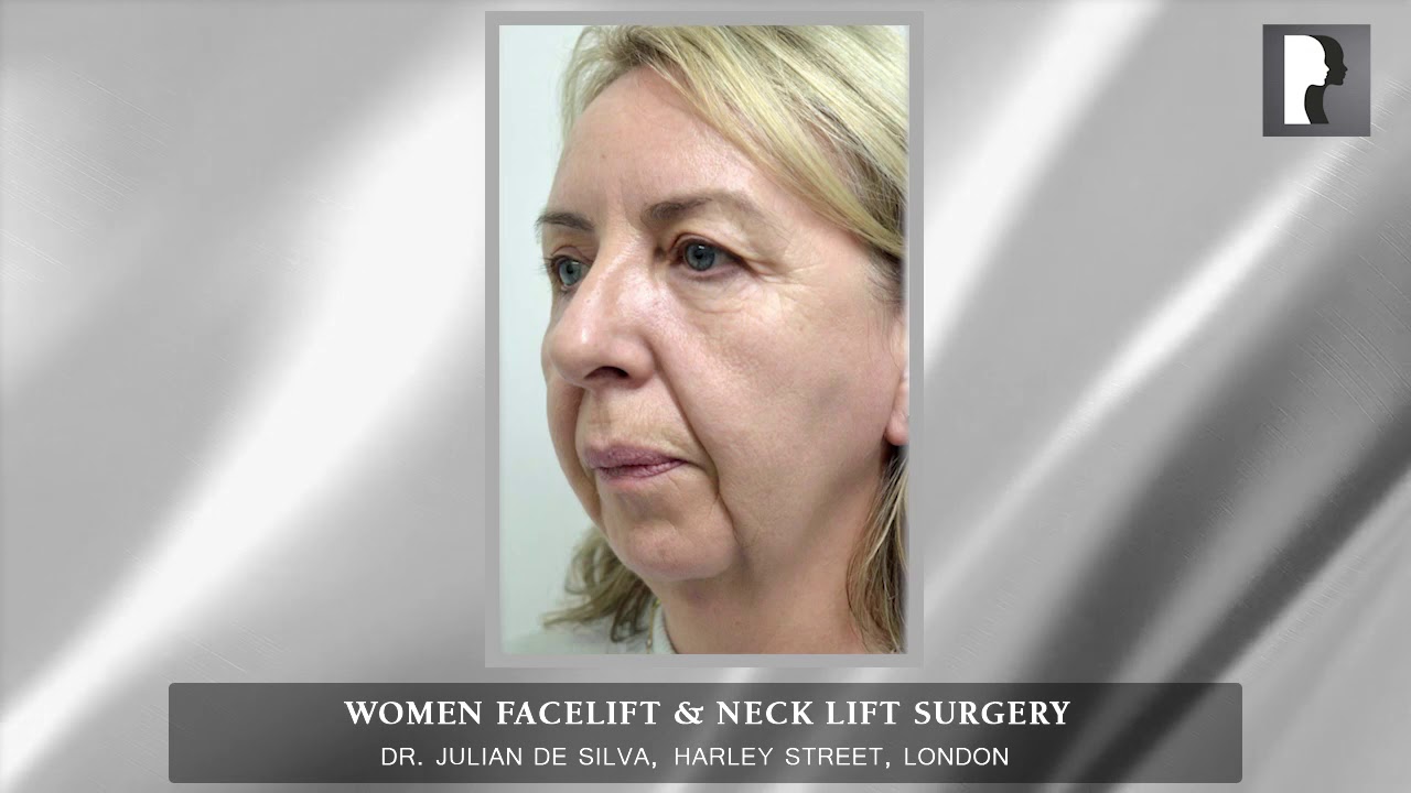Natural Women Facelift & Neck Lift Surgery in London