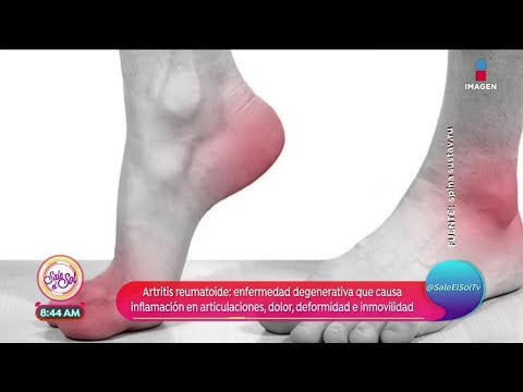 Artritis Reumatoidea