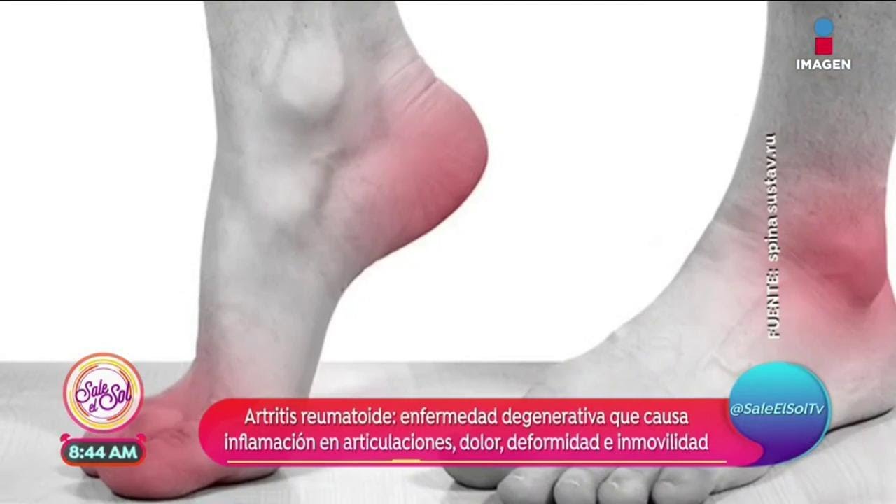 ¿Qué es y cómo se ocasiona la artritis reumatoide | Sale el Sol