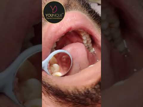 DENTAL MOUTH MIRROR M2 RAINBOW WITH ENDO GAUGE