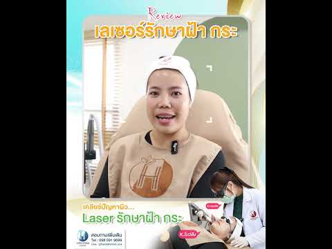 รีวิวหัตถการโปรแกรมเลเซอร์รักษาฝ้ากระ