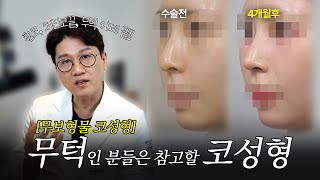 휜코, 처진 코끝 개선! 무턱을 고려한 자연스러운 여자 무보형물 코성형 4개월 경과 (비중격 연골, 비주비순각)