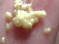 How To Remove Tonsil Stones 