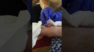 Improvised Bloodletting and Cupping part 3