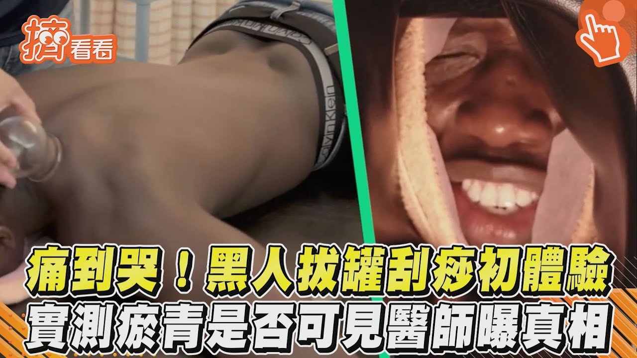 影音/痛到哭!黑人拔罐刮痧初體驗 實測瘀青是否可見醫師曝真相