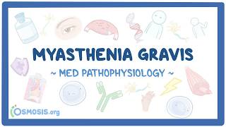 Myasthenia gravis