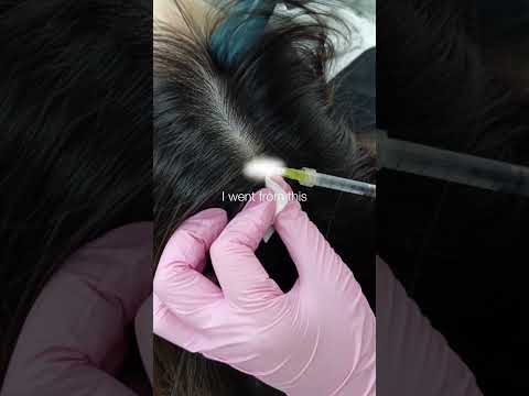 Stop Hair Thinning Early | Exosome Scalp Treatment Result