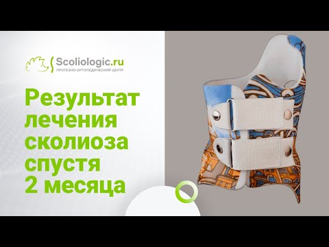 Массаж при сколиозе у детей. Массаж при 4 степенях сколиоза