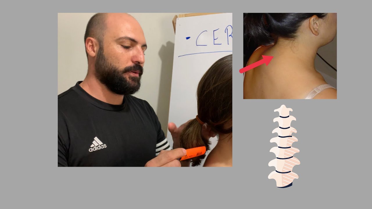 Calombo na nuca, como acabar com apenas esse exercício: #cervical #herniadedisco #artrose