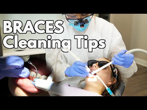 Cleaning Braces (Tips & Tricks for Dental Hygienists)